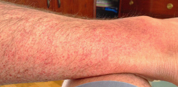 Amoxicillin allergic reaction red spots on skin