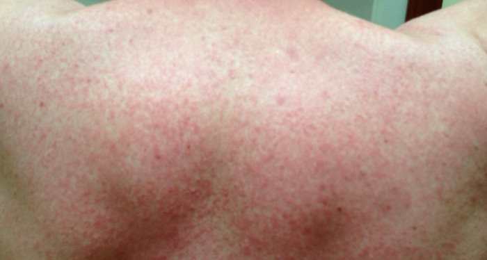 severe Amoxicillin allergy red skin